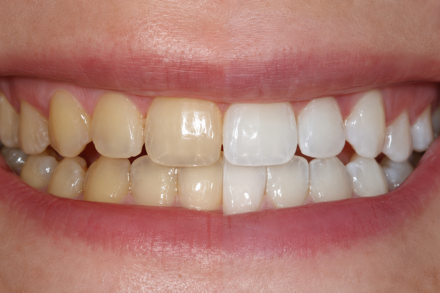 Servicio de blanqueamiento dental