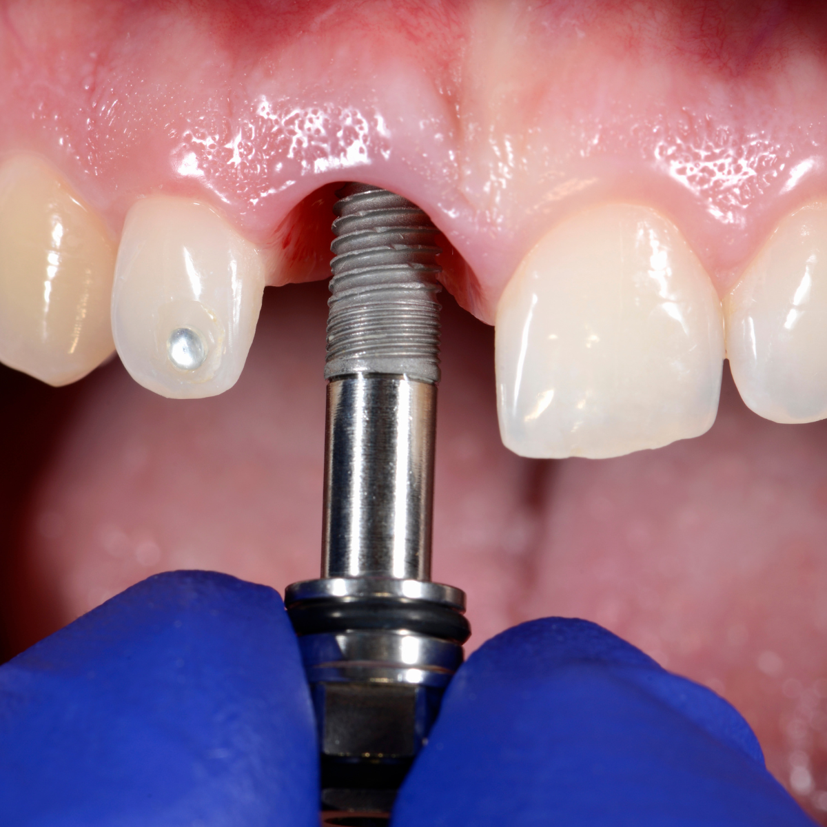 Servicio de implantes dentales
