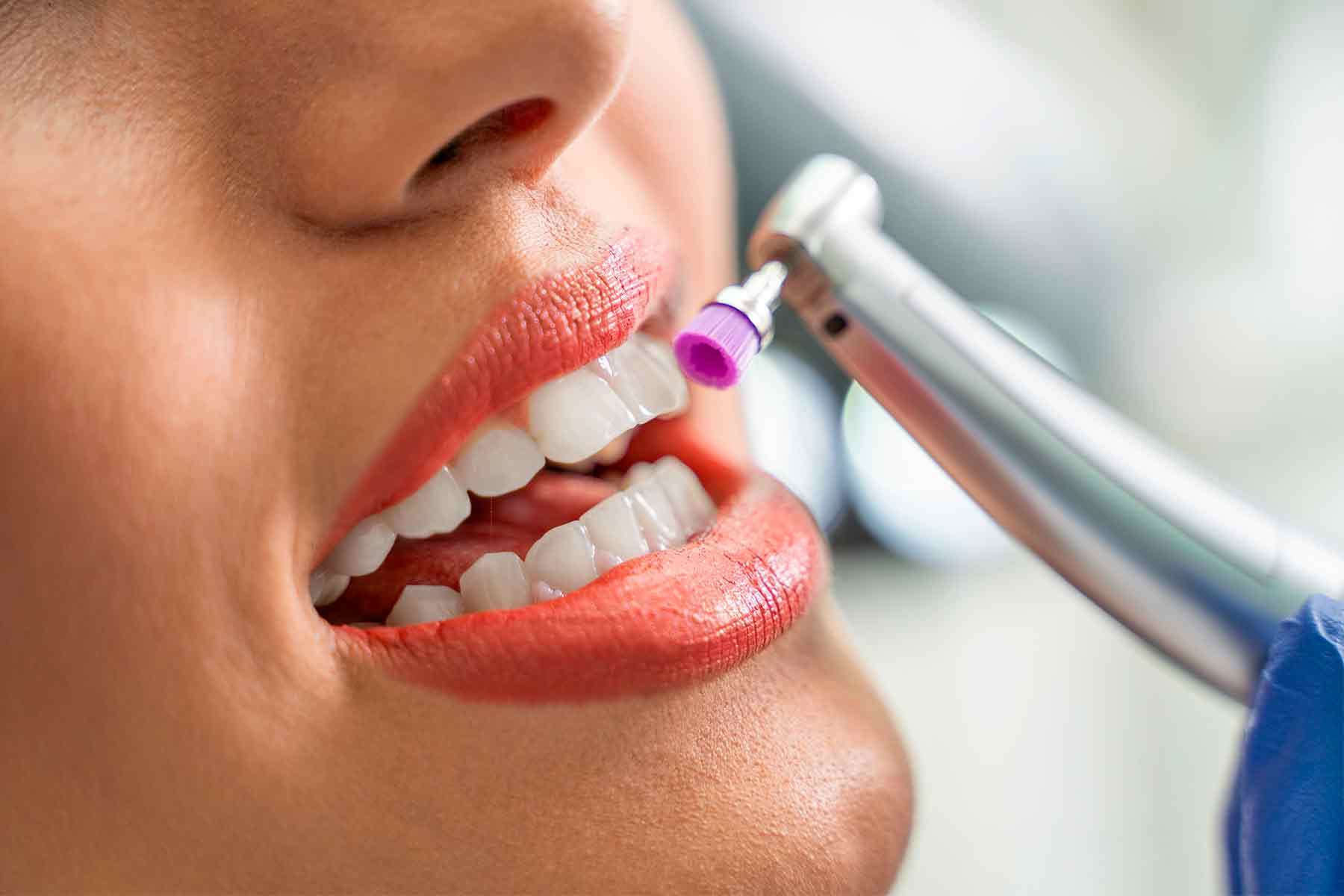 Servicio de limpieza dental